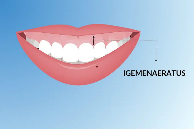 Igemenaeratus ehk gummy smile
