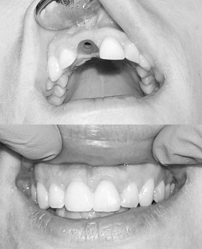 Kohene implantatsioon Kohene implantatsioon before and after